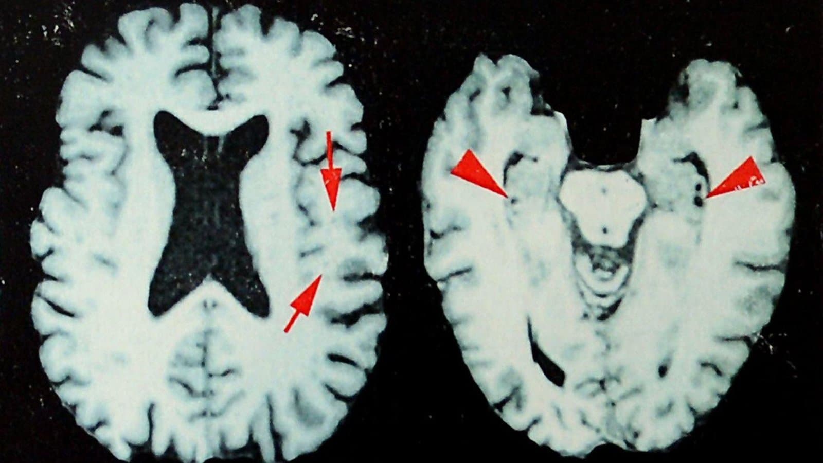 NFL Brain Disease Study Reveals Alarming Prevalence